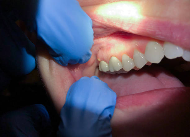 Best Emergency Wisdom Teeth Removal in Oxoboxo River, CT